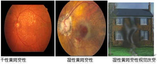 黄斑病变的常见类型及治疗