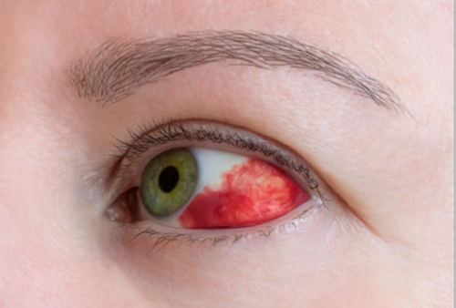 出血 症状 眼底 初期 眼底出血とは？どんな病気？治療法は？