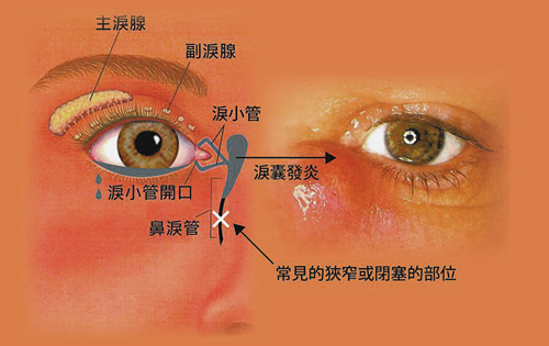 眼睛泪管的位置图片图片