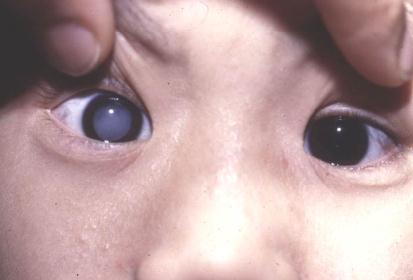 孩子眼珠发白小心是这种严重眼疾,必须及时治疗否则可能有生命危险