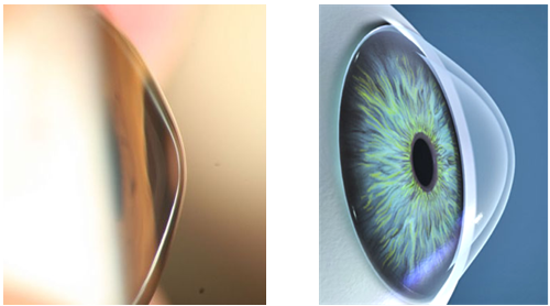 当心与圆锥角膜有关!